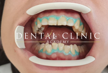 Diş Taşı Temizliği - Diş Beyazlatma